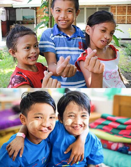 MySmile donates to organizations that gives surgeries to children with cleft palate. MySmile donates to organizations that gives surgeries to children with cleft palate.